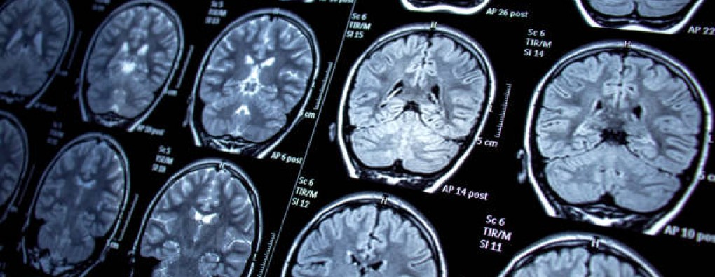 Vanavond webinar 'Palliatieve zorg bij Hersentumoren'. Interview met spreker Walter Taal